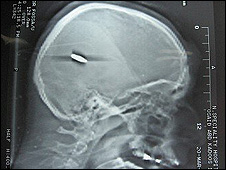 X-ray  of Osayed Qadus's skull showing a bullet lodged inside