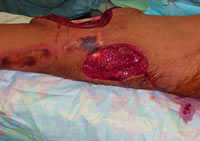 Injured Leg of American Soldier