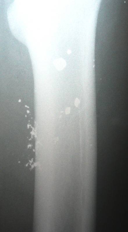 X-Ray of  Hamza Sulaiman Yasin's femur (youth in photo with combat trousers) showing bullet's penetration of  bone and surrounding bone debris
