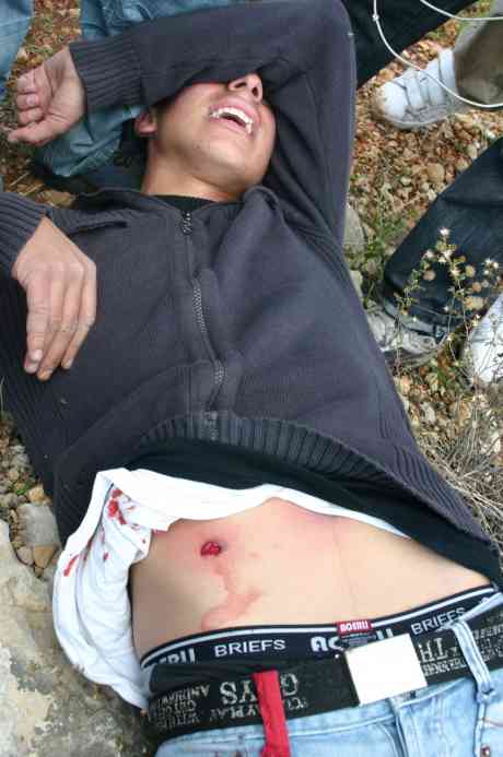 One of the three youths injured by the new bullet (Photo : Haitham Al-Katib)